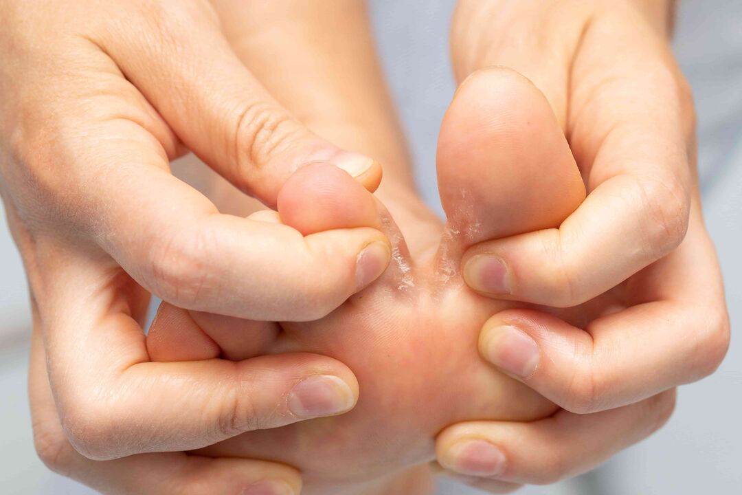 Treatment of fungi between toes and Demyxil cream
