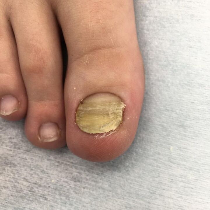 Fungal infection