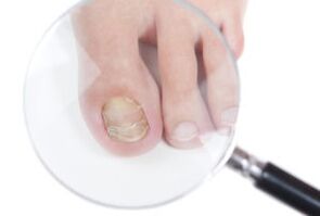 Causes of nail fungi