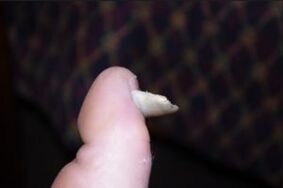 Symptoms of fungi on nails