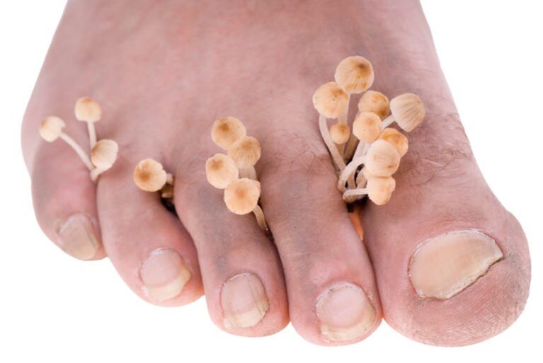 Fungal symptoms on the legs