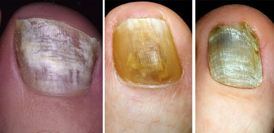In the photo, the color of the nails on the legs with fungal diseases changed.
