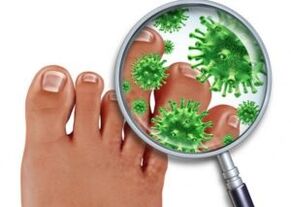 How to Treat Toenail Fungus