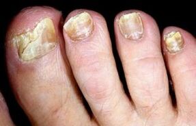 Symptoms of onychomycosis