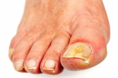 The fungus first affects the nails of the first and fifth toes